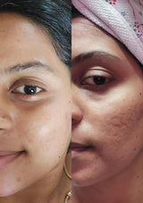 CURE OPEN PORES